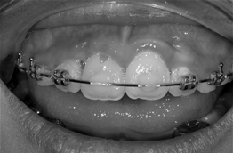 이바른치과교정과치과_강선고정
