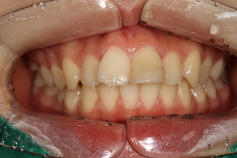 이바른치과교정과치과_교정보철치료전1