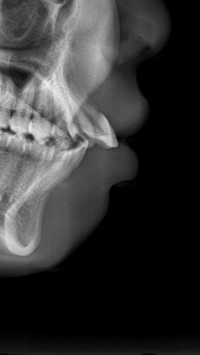 이바른치과교정과치과_교정보철치료전2