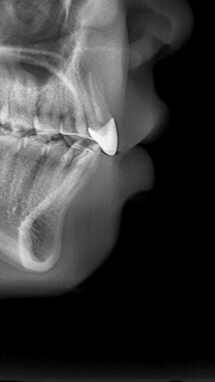 이바른치과교정과치과_교정보철치료후2