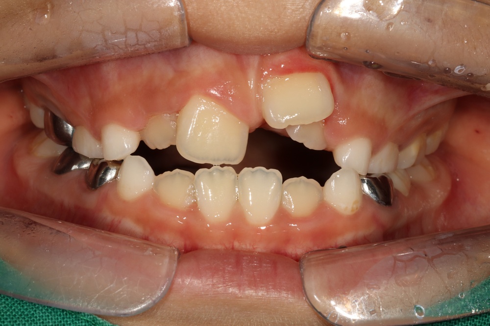 이바른치과교정과치과_어린이치료1치료전