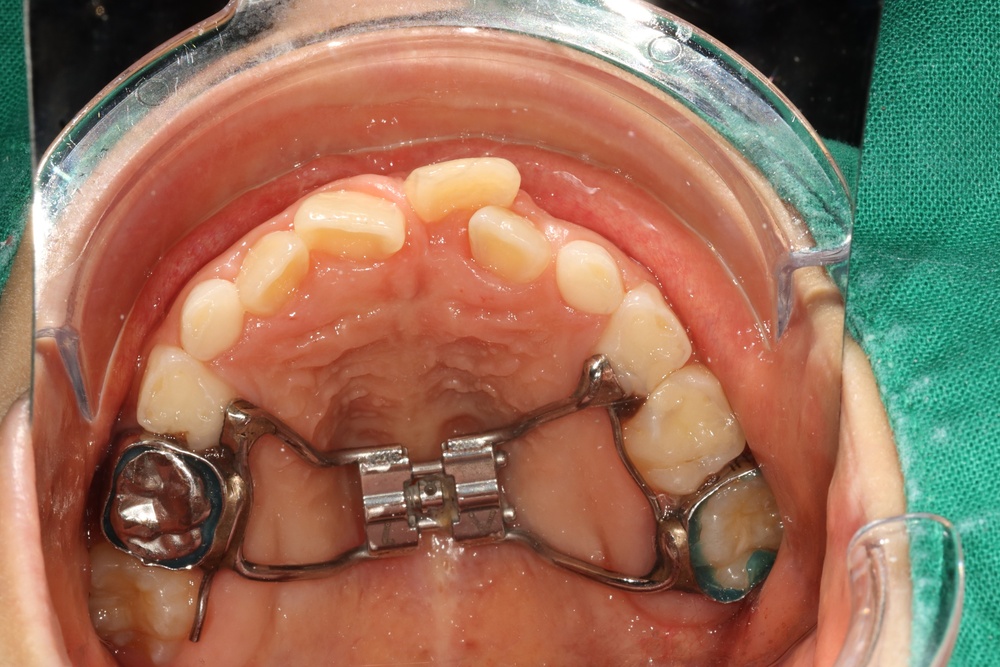 이바른치과교정과치과_어린이치료1치료중1