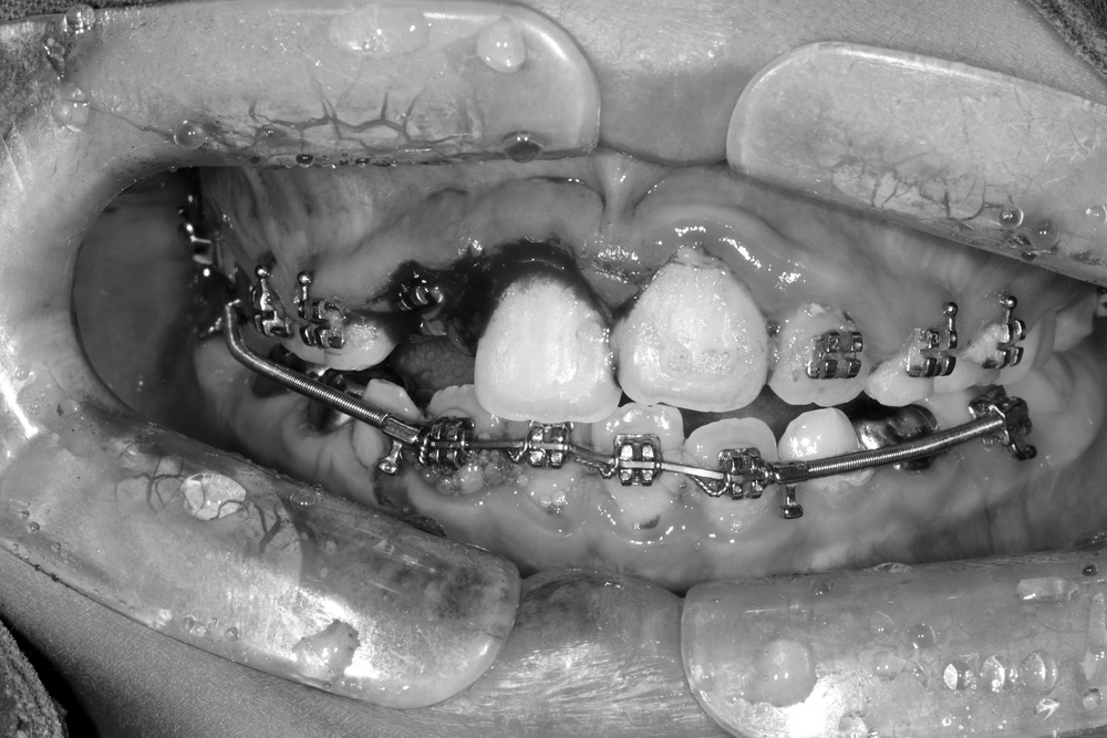 이바른치과교정과치과_어린이치료1치료중2