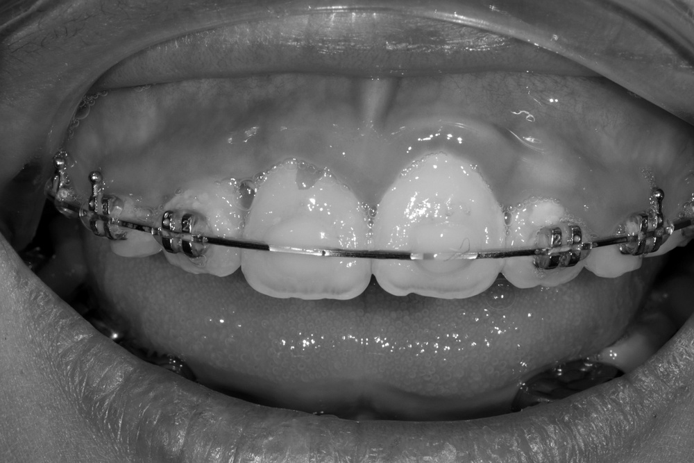 이바른치과교정과치과_어린이치료1치료중3