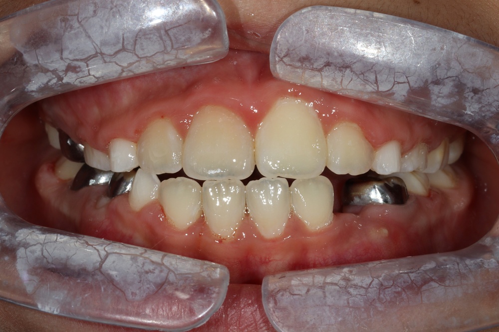 이바른치과교정과치과_어린이치료1치료후