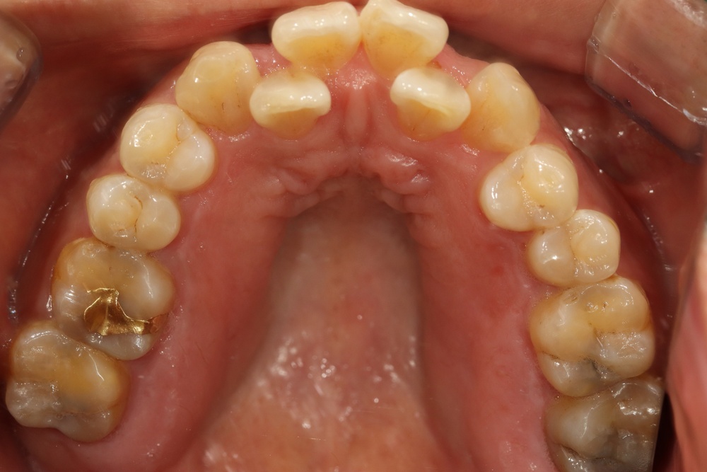 이바른치과교정과치과_중장년교정치료전2