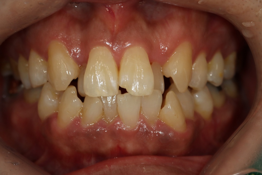 이바른치과교정과치과_중장년교정치료전1