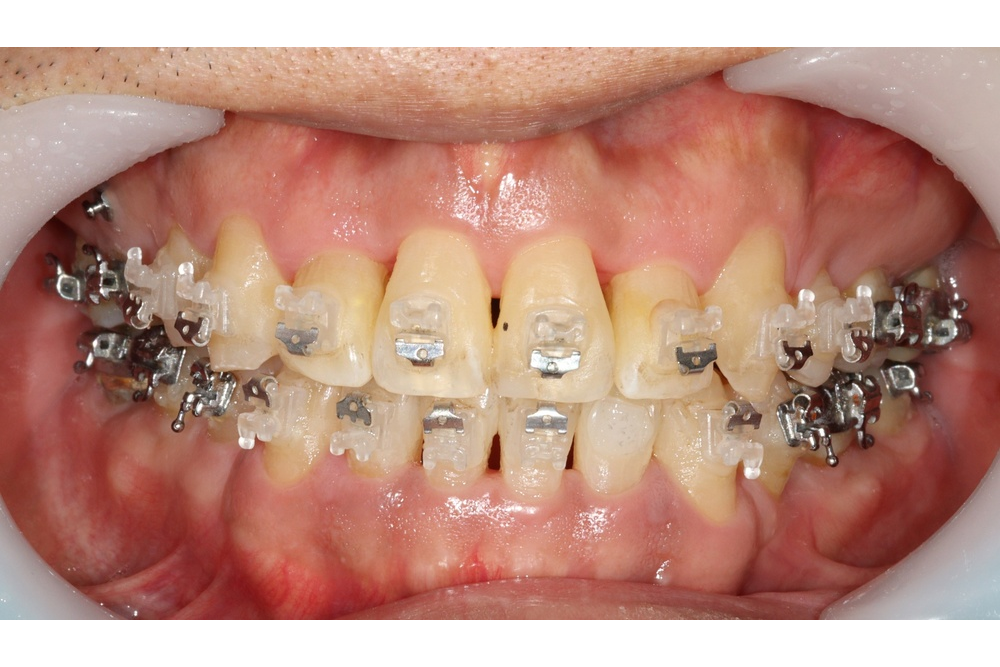 이바른치과교정과치과_중장년교정치료중