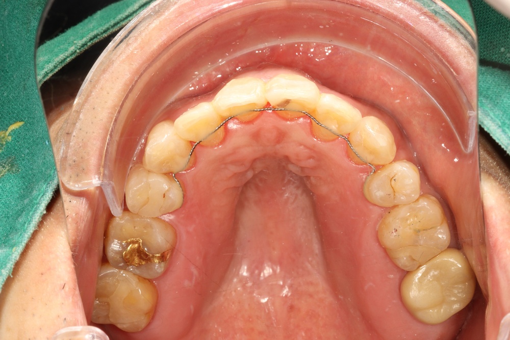 이바른치과교정과치과_중장년교정치료후2