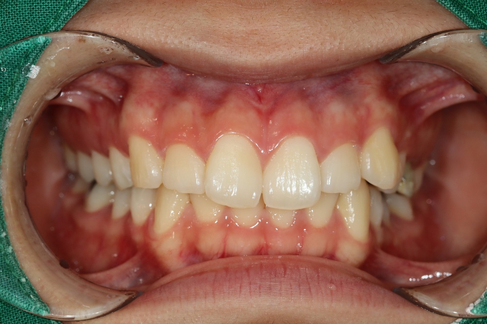 이바른치과교정과치과_돌출입2치료전1