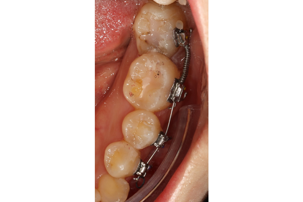 이바른치과교정과치과_매복치치료전1