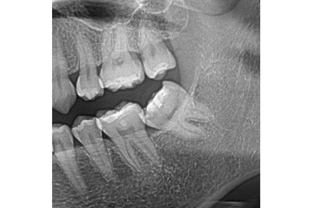 이바른치과교정과치과_매복치치료전2