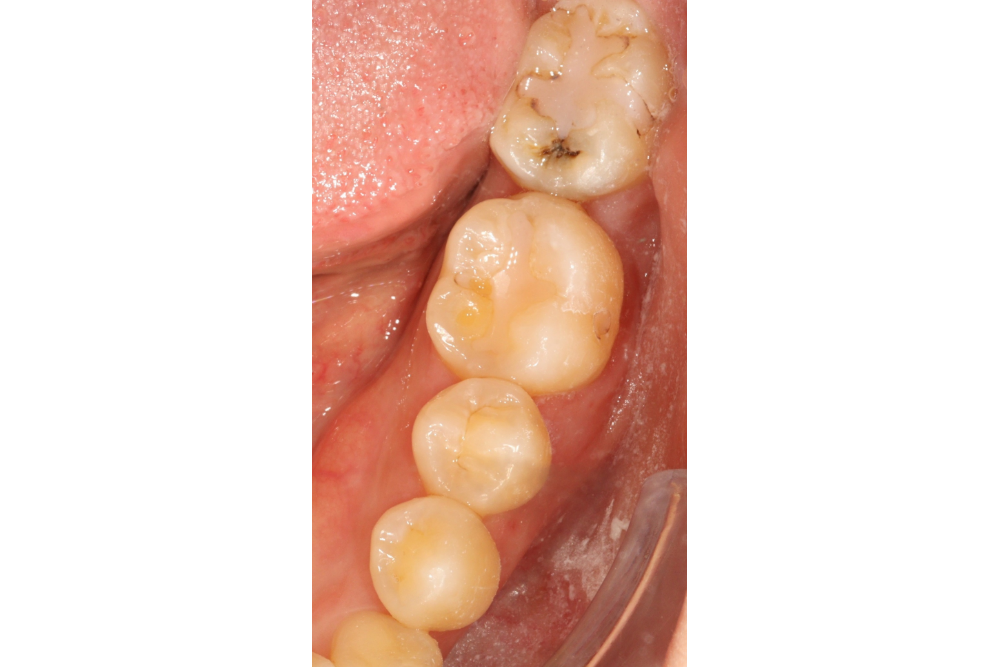 이바른치과교정과치과_매복치치료중