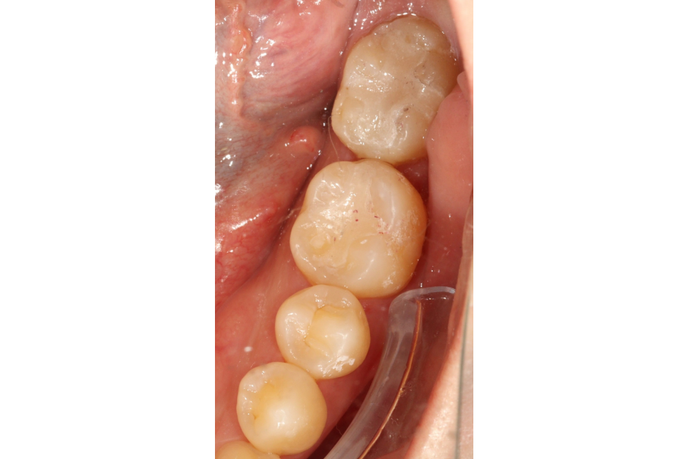 이바른치과교정과치과_매복치치료후1