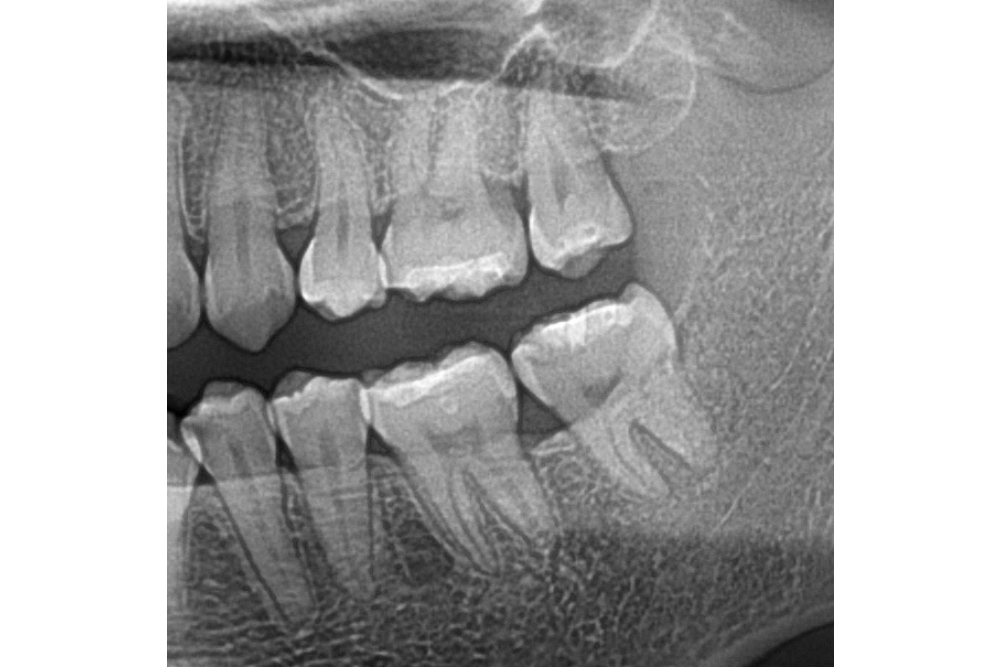 이바른치과교정과치과_매복치치료후2