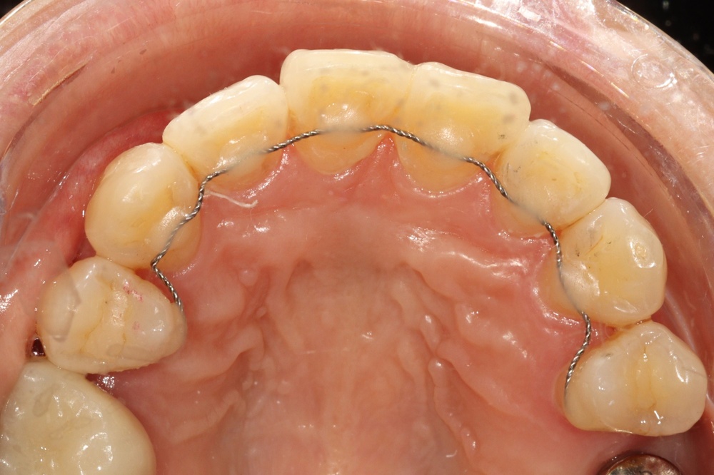 이바른치과교정과치과_유지장치1치료전1
