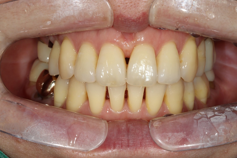 이바른치과교정과치과_유지장치1치료전2