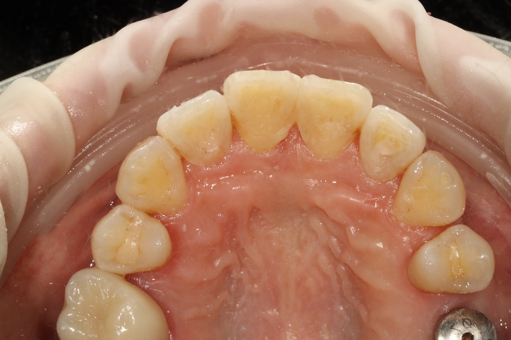 이바른치과교정과치과_유지장치1치료중