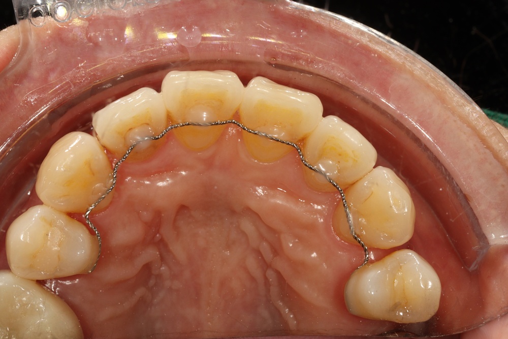 이바른치과교정과치과_유지장치1치료후1
