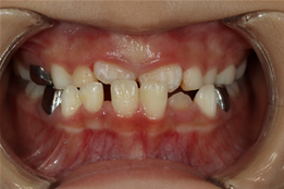 이바른치과교정과치과_어린이치료2치료전