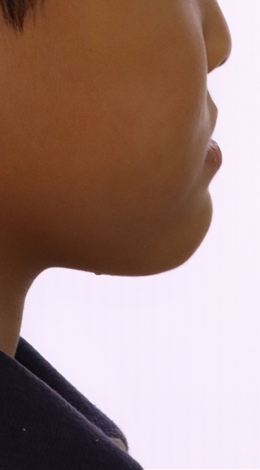 이바른치과교정과치과_어린이치료2치료전2