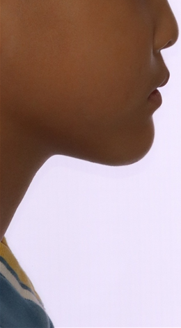 이바른치과교정과치과_어린이치료2치료후2