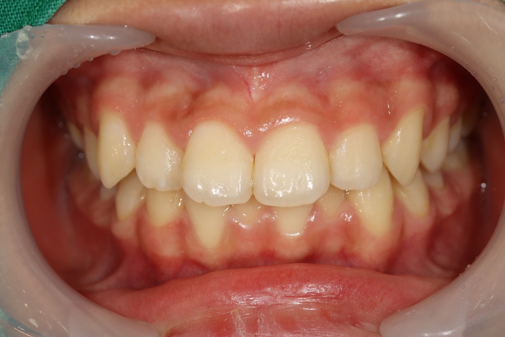 이바른치과교정과치과_교정중2치료전