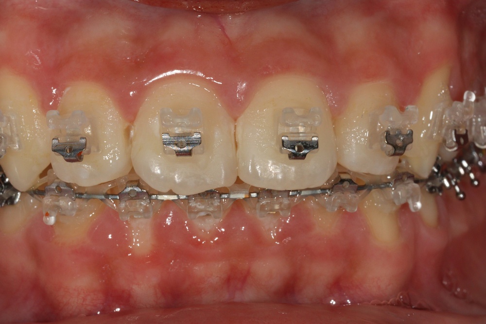 이바른치과교정과치과_교정중2치료중1