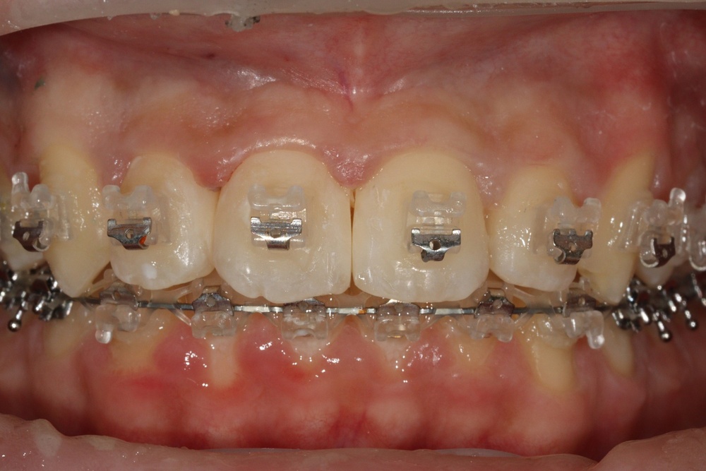 이바른치과교정과치과_교정중2치료중2