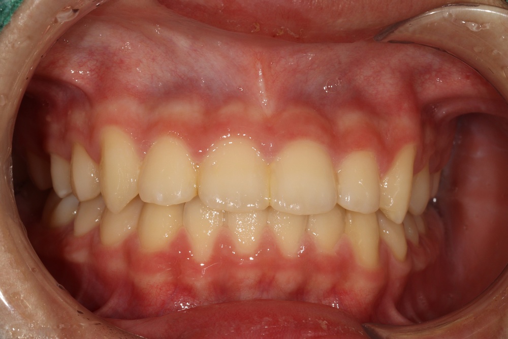 이바른치과교정과치과_교정중2치료후