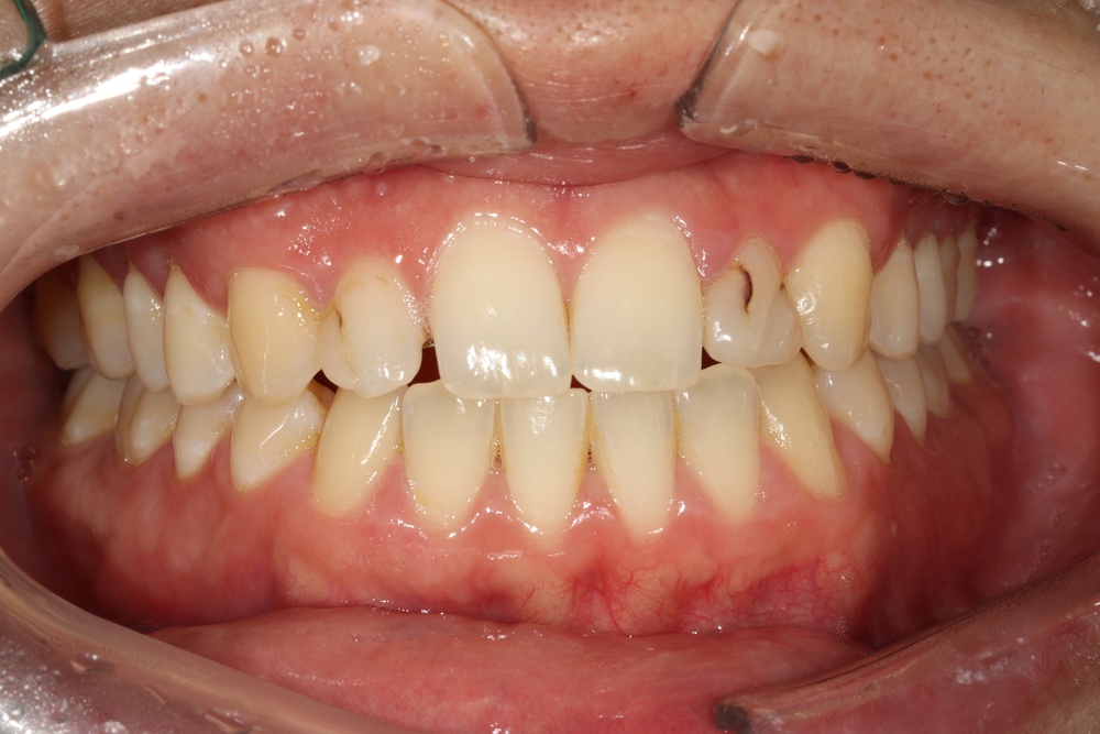 이바른치과교정과치과_유지장치2치료전