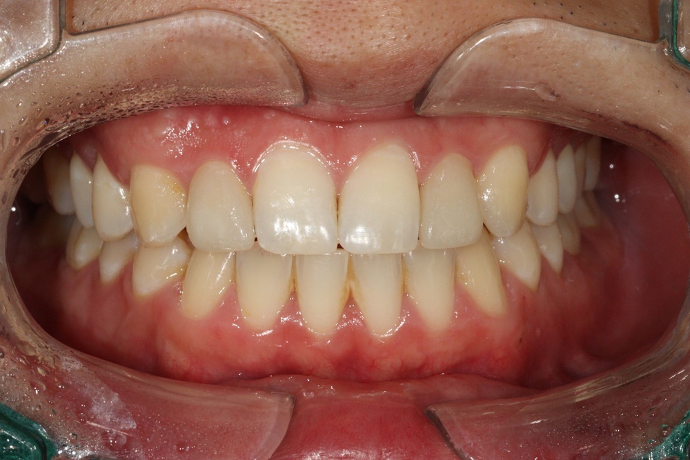 이바른치과교정과치과_유지장치2치료후