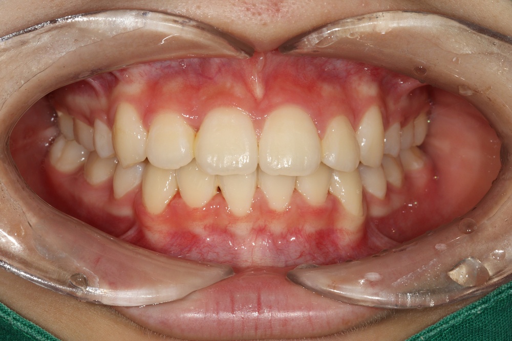 이바른치과교정과치과_덧니교정치료후