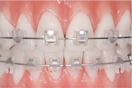 이바른치과교정과치과_자가결찰브라켓