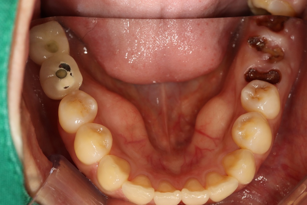 이바른치과교정과치과_교정임플란트치료전2