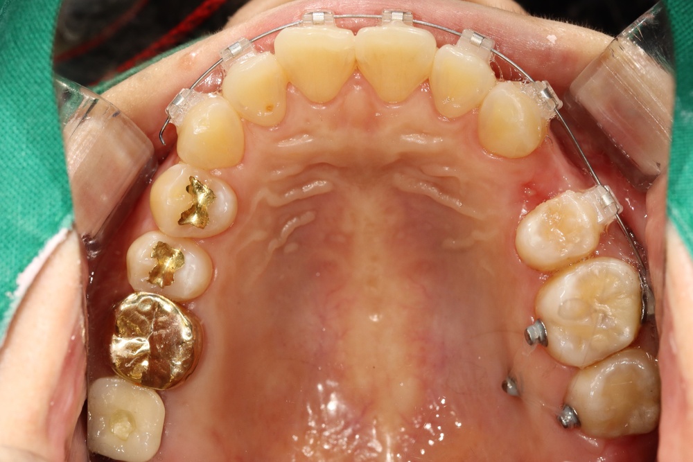 이바른치과교정과치과_교정임플란트치료중