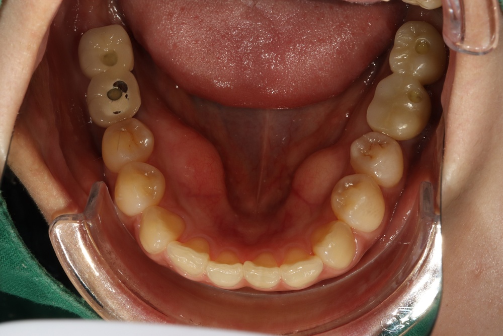 이바른치과교정과치과_교정임플란트치료후2