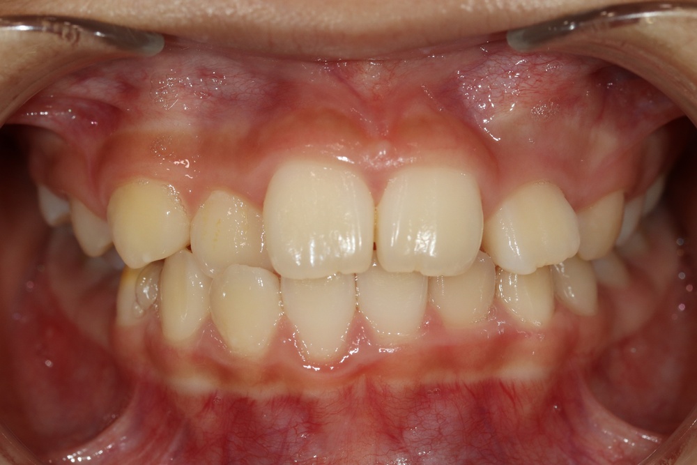 이바른치과교정과치과_돌출입1치료전1