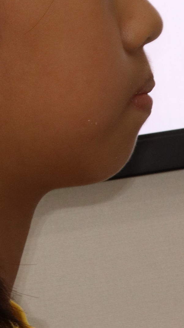 이바른치과교정과치과_돌출입1치료전2