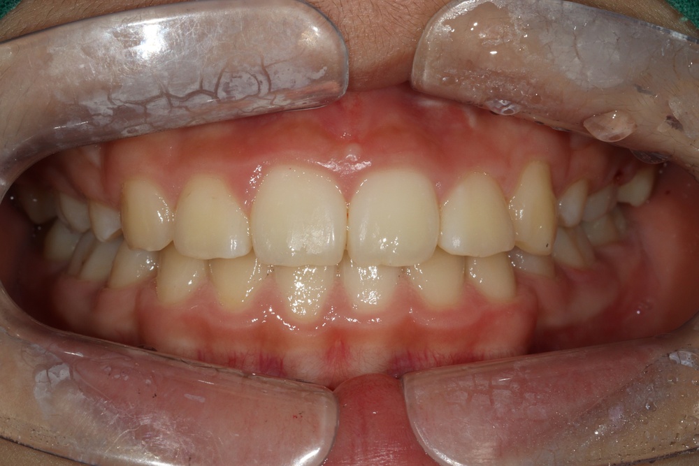 이바른치과교정과치과_돌출입1치료후1