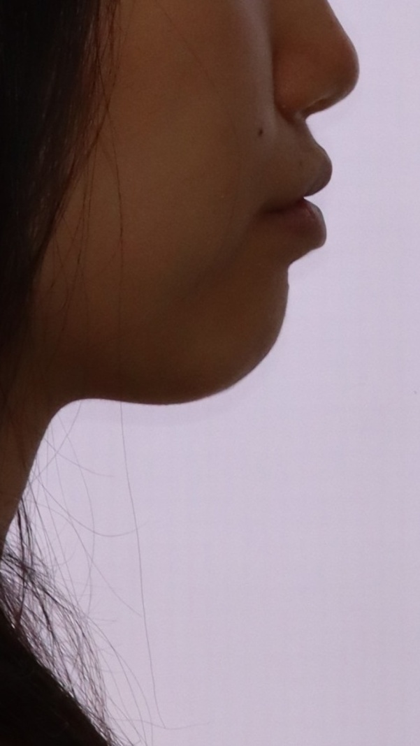 이바른치과교정과치과_돌출입2치료전2