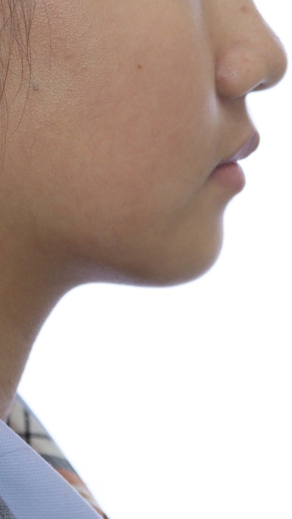 이바른치과교정과치과_돌출입1치료후2