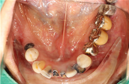 이바른치과교정과치과_임플란트