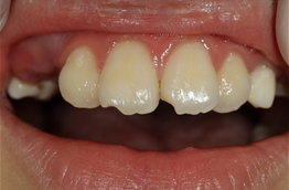 이바른치과교정과치과_파절된치아치료전