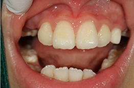 이바른치과교정과치과_파절된치아치료후