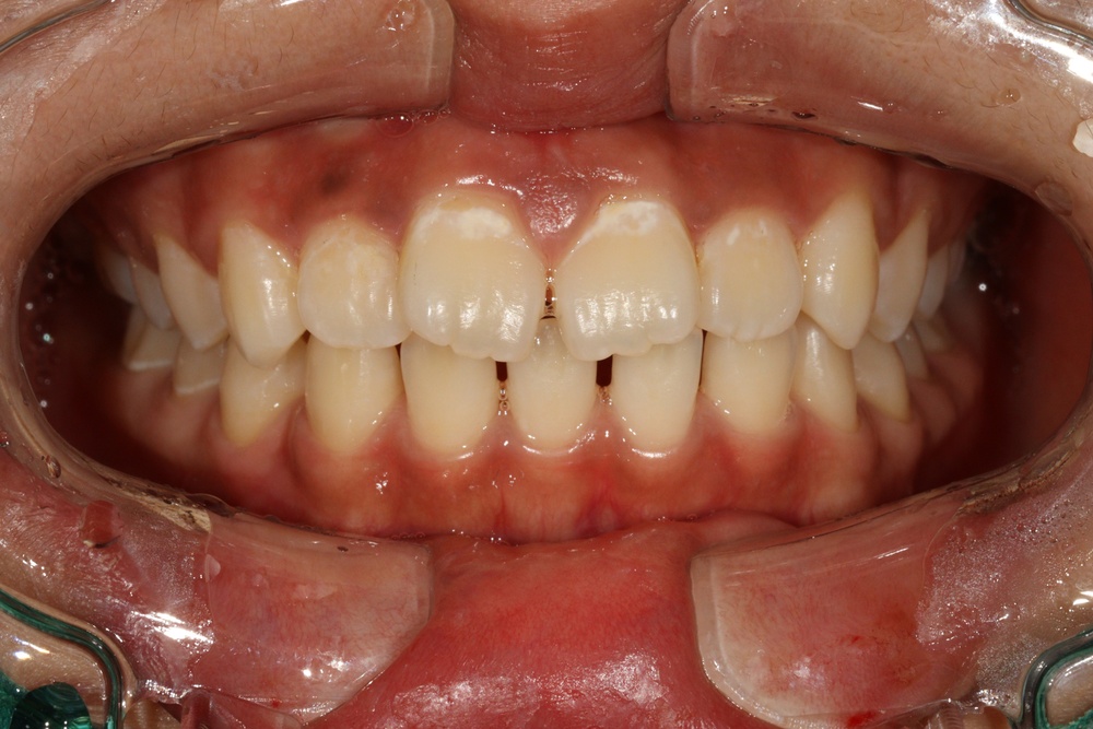 이바른치과교정과치과_교정중1치료전